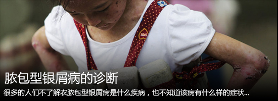 脓疱型银屑病的诊断