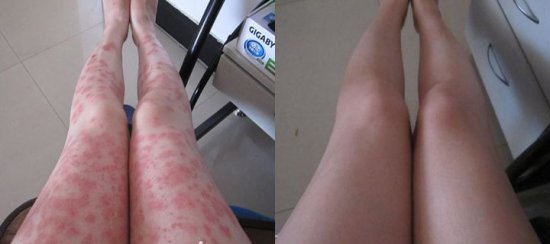 银屑病怎么治疗才最好
