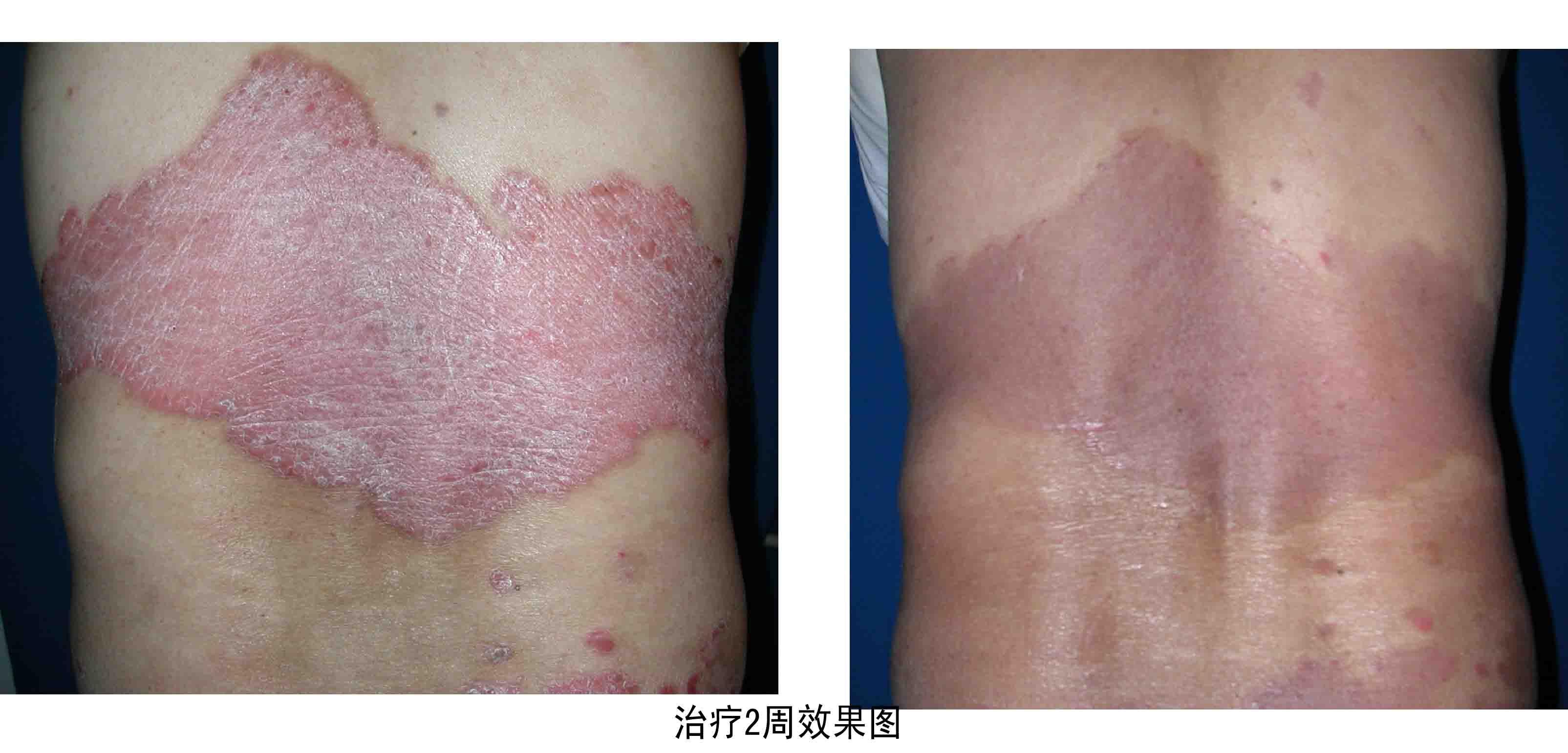 分析银屑病的主要预防注意事项有哪些
