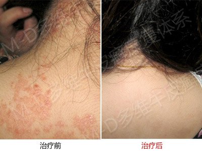 银屑病预防知识