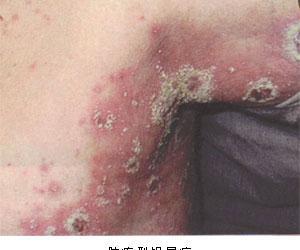 关节型银屑病