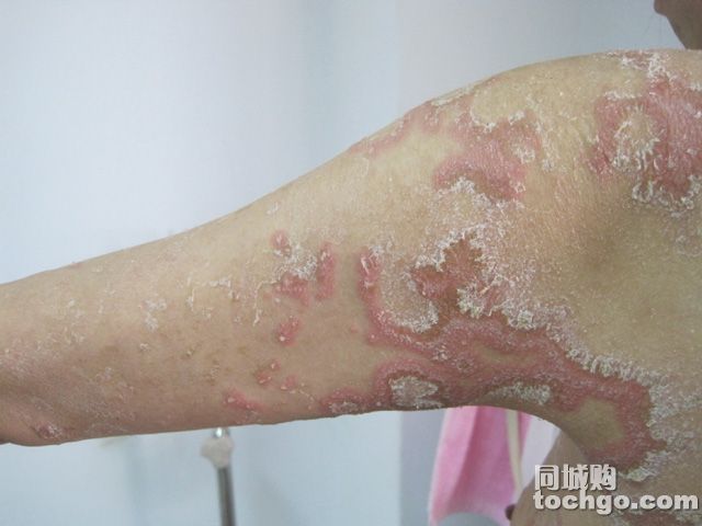 关节型银屑病
